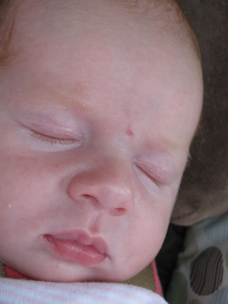 Strawberry Hemangioma PHOTOS | BabyCenter