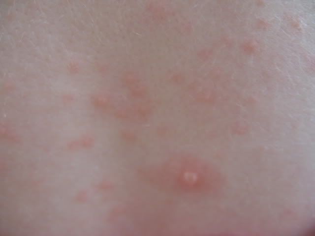 Pic Of Herpes On Lip - Doctor answers on HealthTap